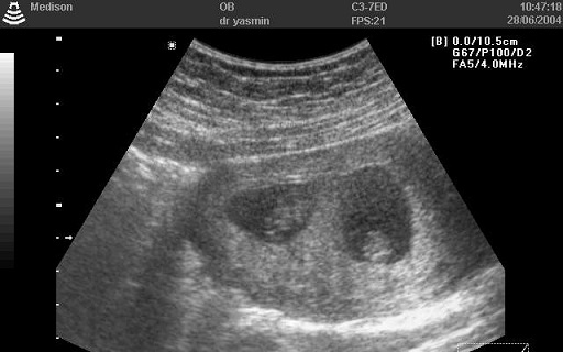 Csak a szülésnél döbbent rá, hogy állapotos