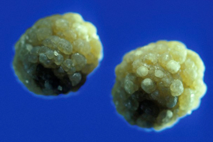 Drágakőnek hitt epeköveket lopott egy férfi Kecskeméten