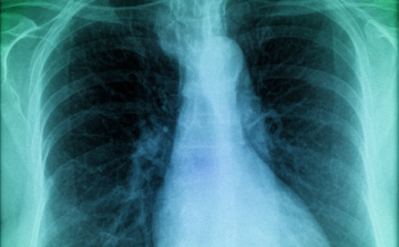 Kísérleti eljárás támaszthatja fel a tüdőt