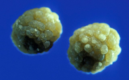 Drágakőnek hitt epeköveket lopott egy férfi Kecskeméten